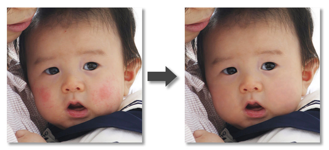 新生児の頬-Before-After